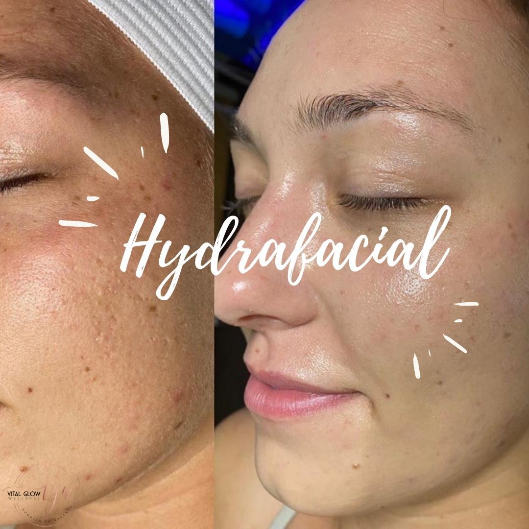 HydraFacial before and after: clearer, hydrated skin